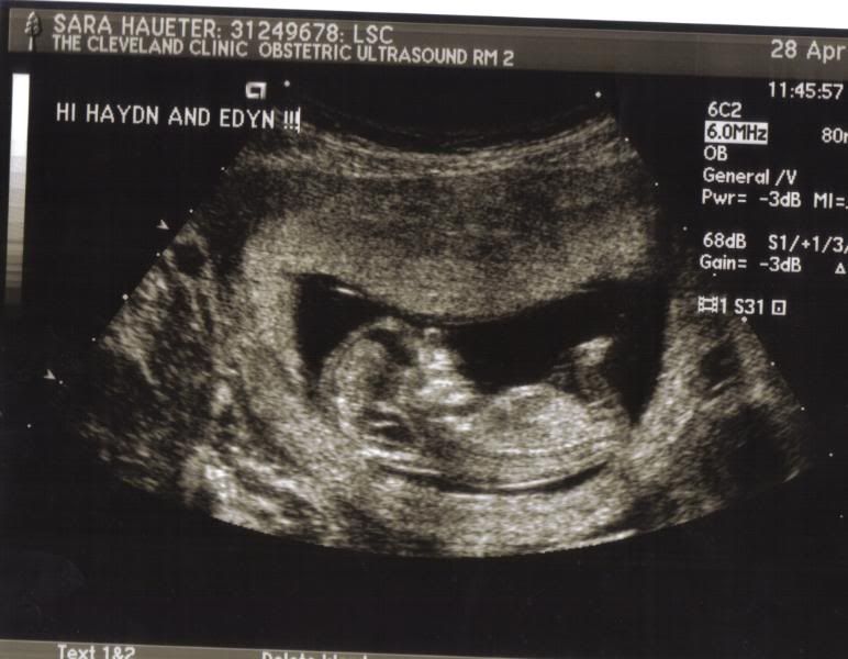 Post Your Confirmed BOY Nub Theory and Potty Shots Here in Ultrasound Gender Prediction Forum