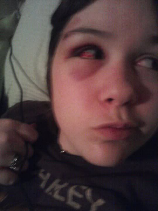 a blood vessel popped in my eye