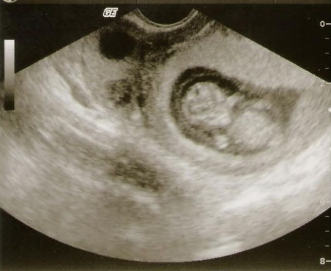 ultrasound 8 weeks. Ultrasound+8+weeks+5+days
