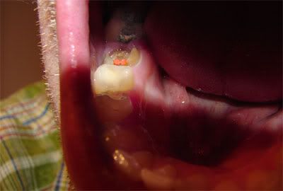 The orange spots are the filled root 'canals'.