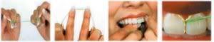flossing_technique-1.jpg