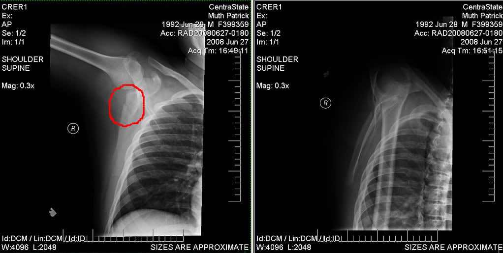 Broken Scapula Scapula, Info, Medical